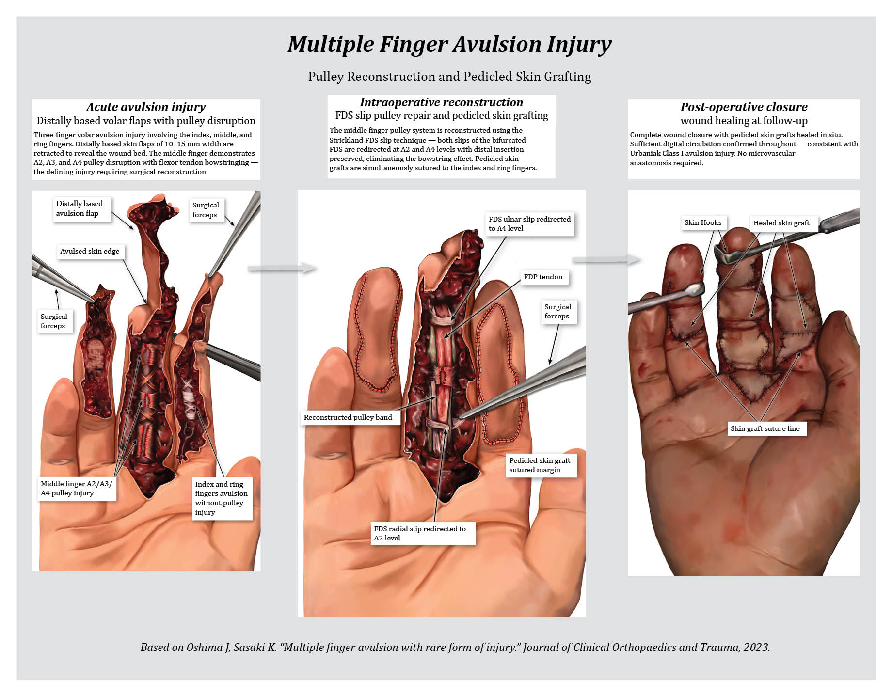 Multiple Finger Avulsion Injury — three-panel surgical illustration series