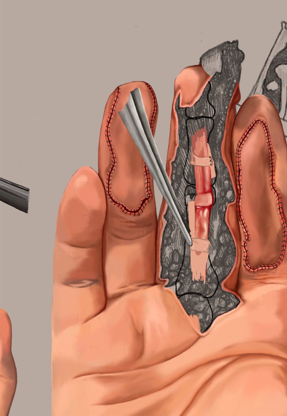 Work in progress: blocking in and refining the central graft and tendon detail