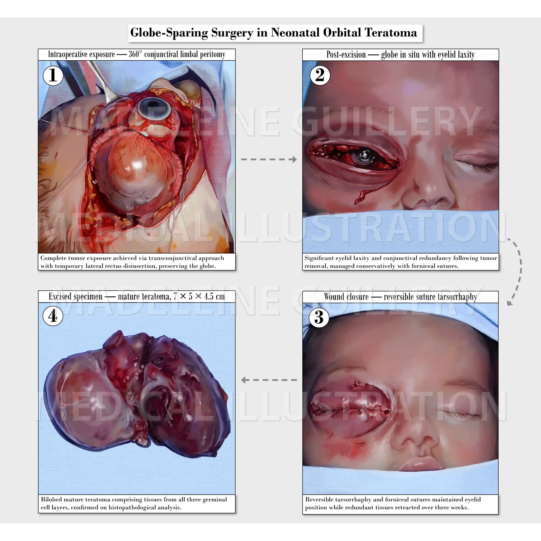 Final published illustration plate: Globe-Sparing Surgery in Neonatal Orbital Teratoma, four-panel surgical series