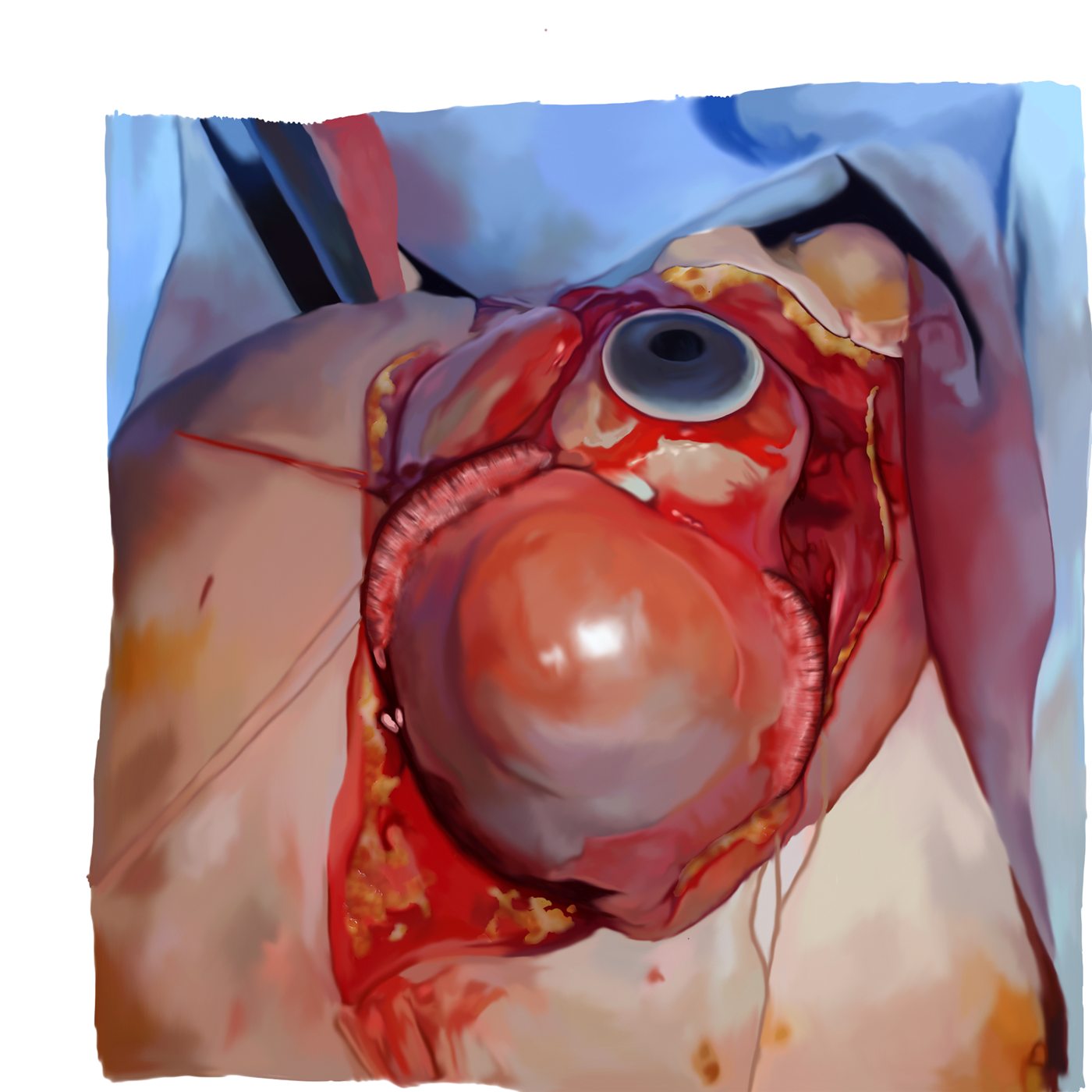 Globe-Sparing Surgery in Neonatal Orbital Teratoma — intraoperative exposure panel