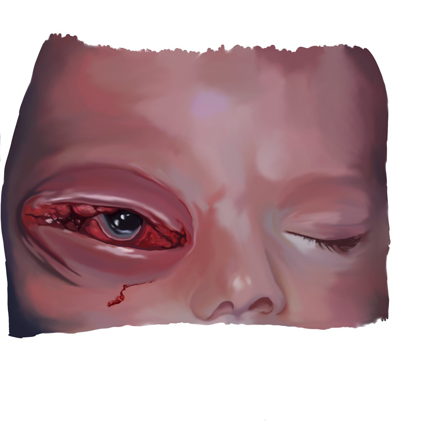 Work-in-progress panel: post-excision stage