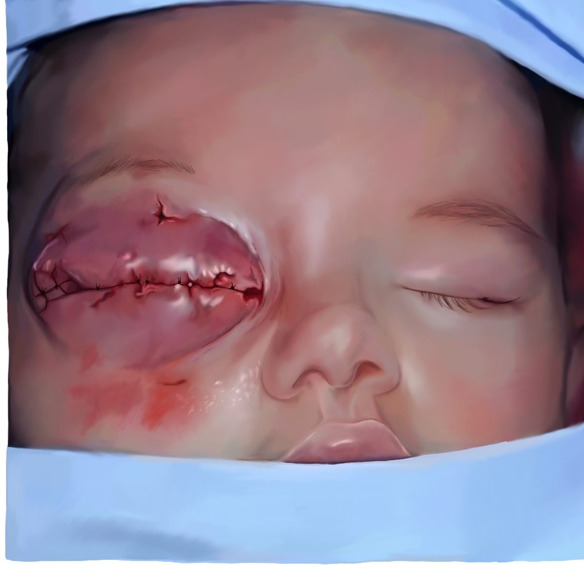 Featured work by Madeleine Guillery — Globe-Sparing Surgery in Neonatal Orbital Teratoma