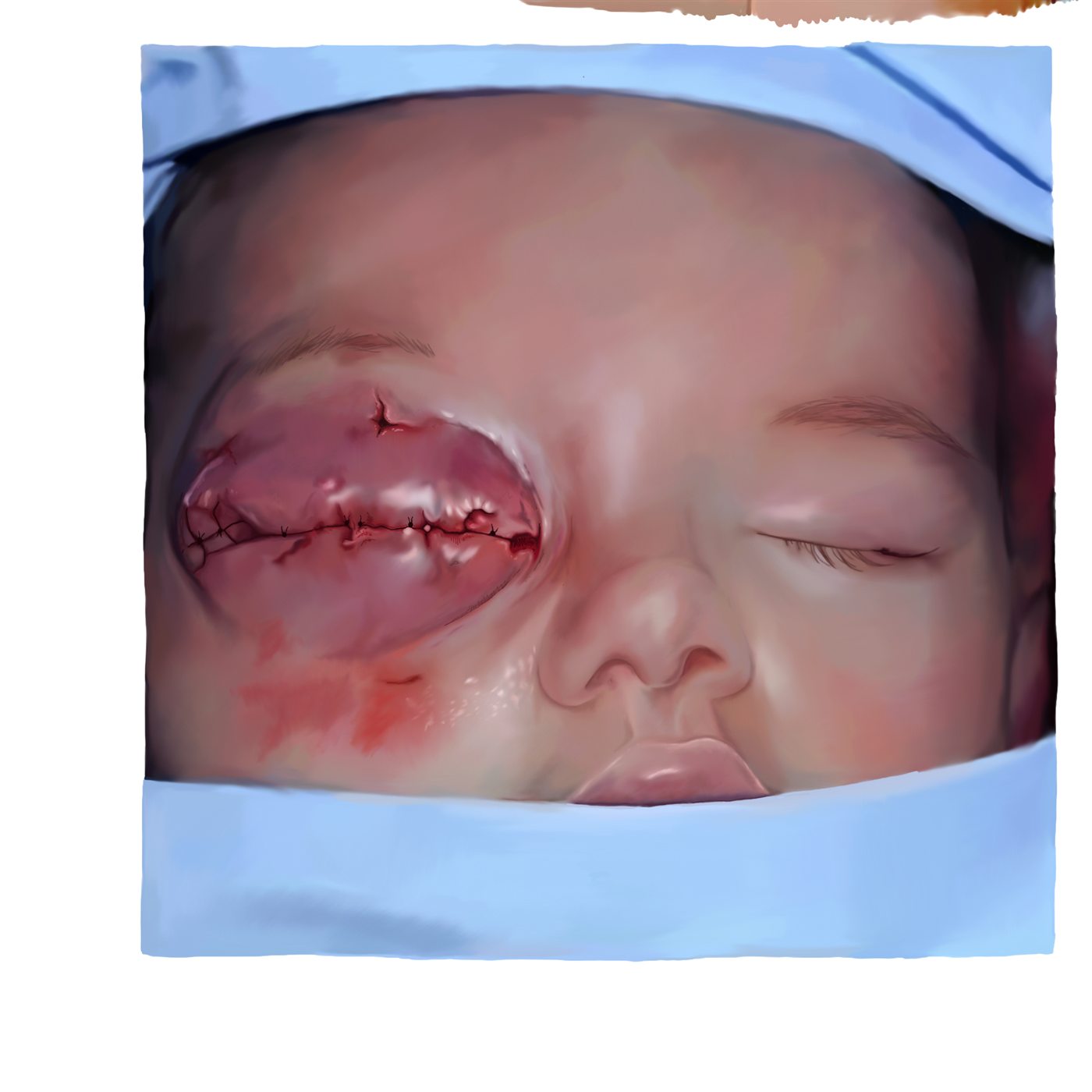 Work-in-progress panel: wound closure stage
